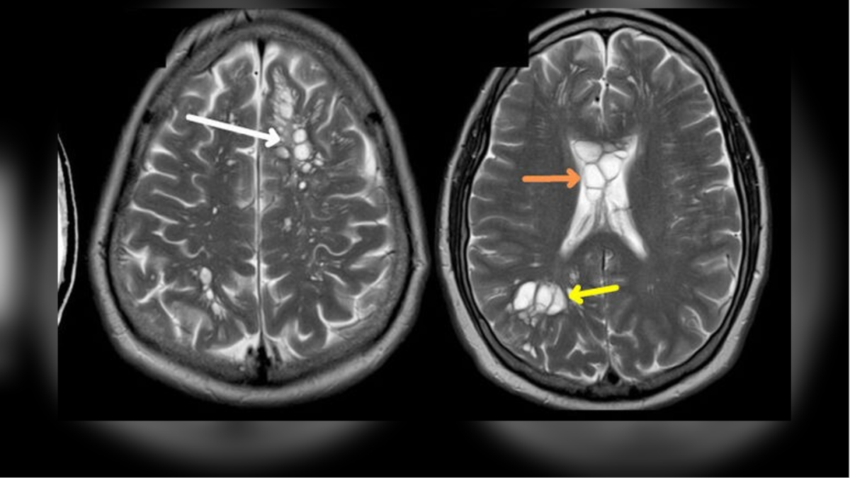 Hombre acude al hospital por migraña; le encuentran larvas en el cerebro